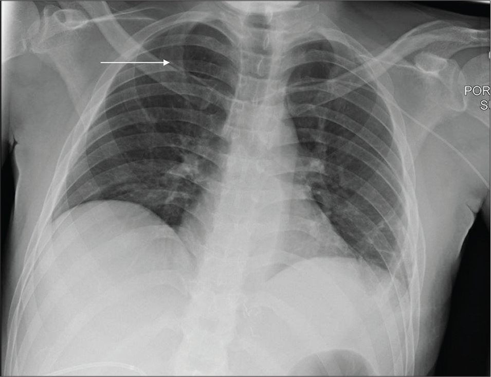 A 36-year-old male with the right renal malignancy post-surgical resection admitted in ICU. Portable chest radiograph reveals malpositioned left subclavian approach central venous catheter with the tip in the right subclavian vein (white arrow).