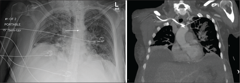 A 46-year-old male with acute septic shock admitted in ICU. (a) Portable chest radiograph demonstrates malpositioned right subclavian approach central venous catheter crossing the midline and terminating at the expected location of aortic arch (white arrow). A central venous catheter crossing the midline should raise the suspicion of arterial placement. There are diffuse heterogeneous airspace opacities bilaterally suggestive of multifocal pneumonia. (b) Coronal chest CT MIP images of the same patient confirm arterial placement of the right central venous catheter (white arrow) and scattered multifocal opacities suggestive of multifocal pneumonia.