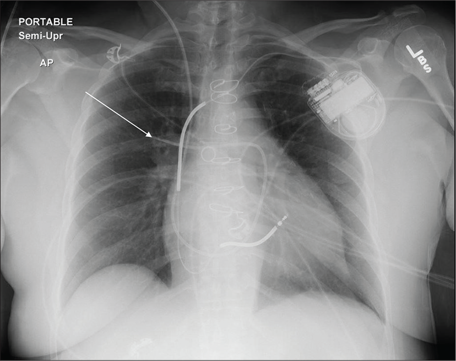 A 46-year-old female post-CABG admitted in cardiac ICU. Portable chest radiograph demonstrates right IJV approach catheter terminating in the right lower lobe segmental branch pulmonary artery (white arrow). Other support devices are appropriately positioned.