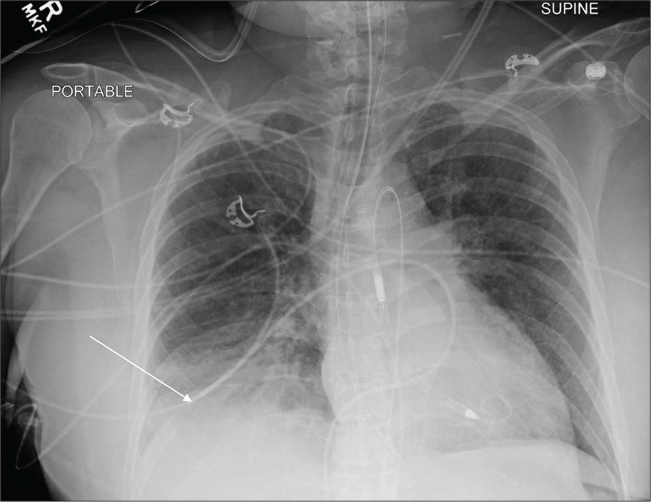 A 59-year-old female with ventricular tachyarrhythmia and cardiac arrest admitted in cardiac ICU. Portable chest radiograph demonstrates right femoral (inferior) approach Swan-Ganz catheter terminating in the right lower lobe segmental branch pulmonary artery (white arrow). Other support devices are appropriately positioned.