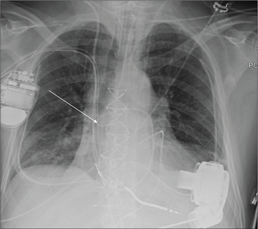 A 61-year-old male with cardiac failure and post-LVAD placement admitted in cardiac ICU. Portable chest radiograph demonstrates right IJV approach Swan-Ganz catheter coiled within the mid-right pulmonary artery (white arrow). Other support devices are appropriately positioned.