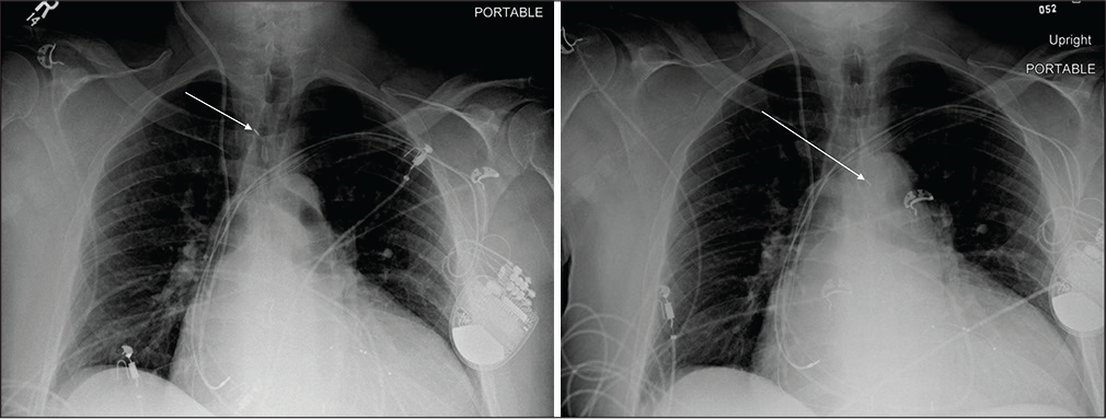 A 52-year-old male with ischemic cardiomyopathy admitted in cardiac ICU. Portable chest radiograph demonstrates right axillary approach IABP with its proximal tip at the expected location of the right innominate artery (white arrow). The distal tip of IABP is not in the field of view. In this scenario, the radiologist should recommend advancement of the IABP catheter. Other support devices are appropriately positioned. (b) Repeat chest radiograph of the same patient demonstrates interval advancement of the right axillary approach IABP with proximal tip projecting over the proximal aortic arch (white arrow) and distal tip projecting over the descending thoracic aorta.