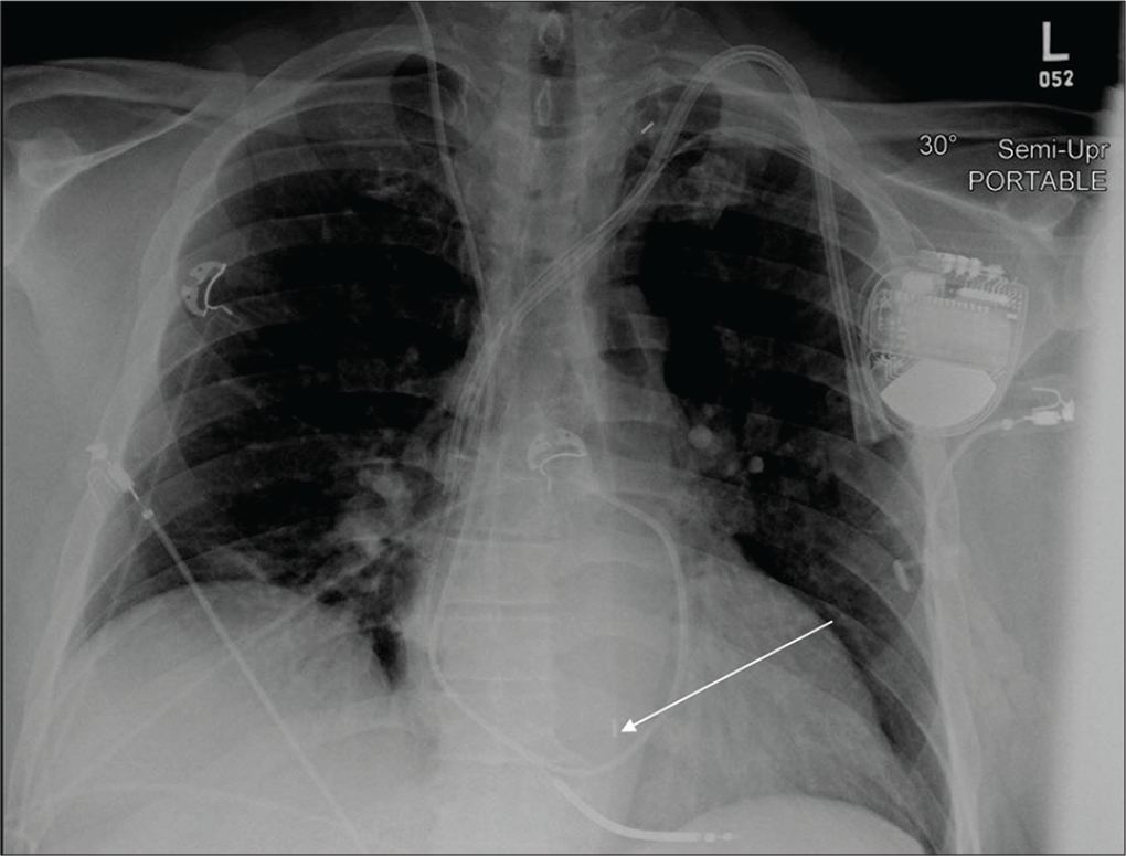 A 62-year-old male with thyroid malignancy and coronary atherosclerosis admitted in cardiac ICU post-myocardial infarction. Portable chest radiograph demonstrates femoral approach IABP with its distal tip lying very low 9 cm from the superior aspect of aortic arch (white arrow). The proximal tip is not visualized in the field of view. In this scenario, the radiologist should recommend advancement of the femoral approach IABP catheter.