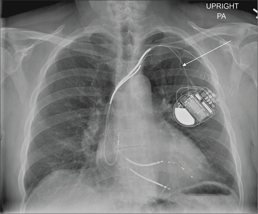 A 55-year-old male with a medical history of arrhythmia and treated with biventricular defibrillator presented to the cardiology outpatient clinic with worsening palpitations for the past 1 week. PA chest radiograph demonstrates fracture of one of the pacemakers/AICD leads (white arrow).