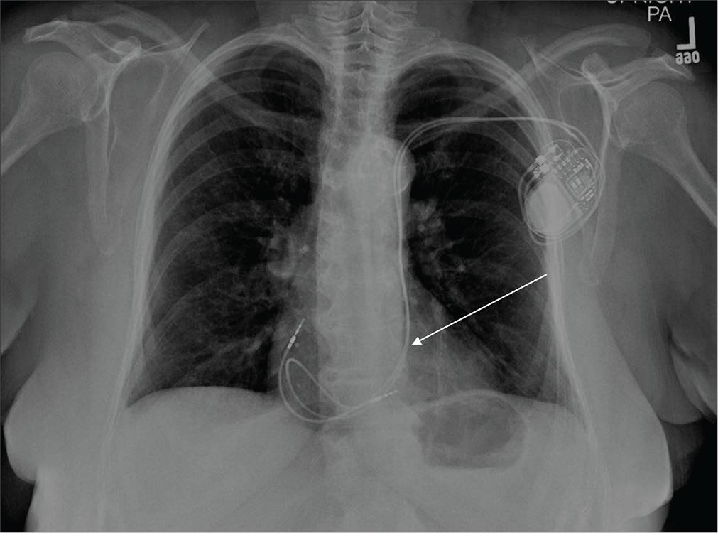 A 59-year-old female with new-onset arrhythmia underwent chest radiograph post-pacemaker placement. PA chest radiograph demonstrates left chest wall AICD with anomalous course of pacemaker lead through left-sided SVC with the leads in the right atrium and right ventricle (white arrow).