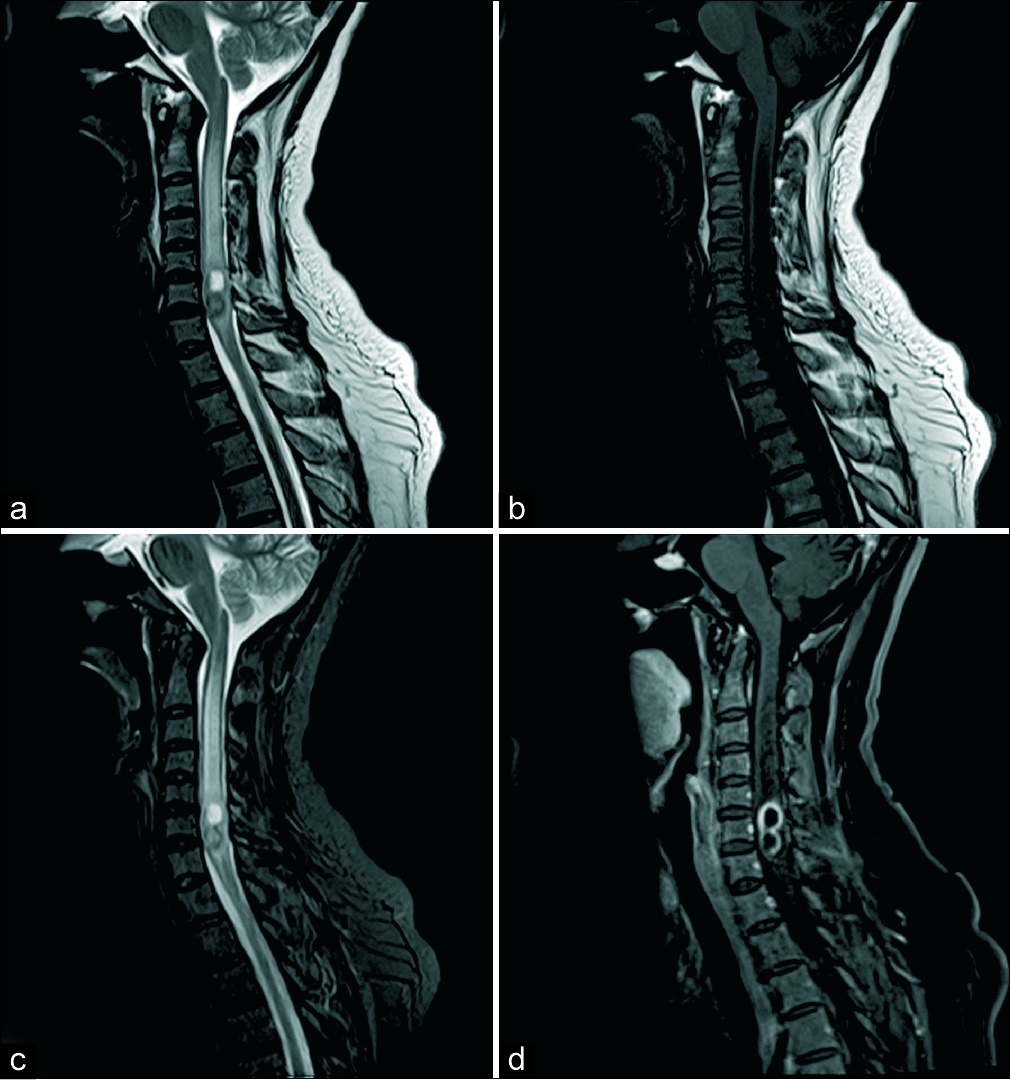 (a) Sagittal T2 turbo spin-echo (TSE) image showing intramedullary lesion at C5, C6 with extensive surrounding cervical cord hyperintense signal. The lesion appears lobulated with the superior component appearing hyperintense and lower component showing an intense hypointense rim, (b) sagittal T1 TSE image showing the superior component hypointense and the lower component isointense to the cord parenchyma, (c) sagittal T2 FS image, and (d) post-contrast sagittal FS image showing peripheral rim enhancement of the lobulated lesion.