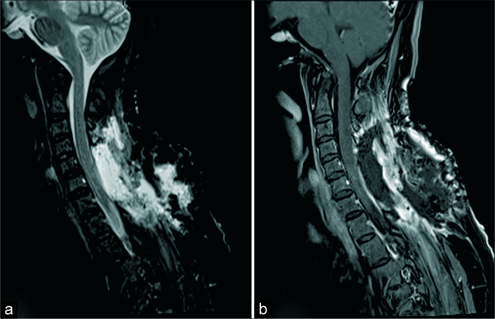 Post-operative T2 FS (a) and sagittal T1 FS (b) images. Post-surgical changes in the cervical region. No intramedullary lesion is seen. The cord signal has improved.