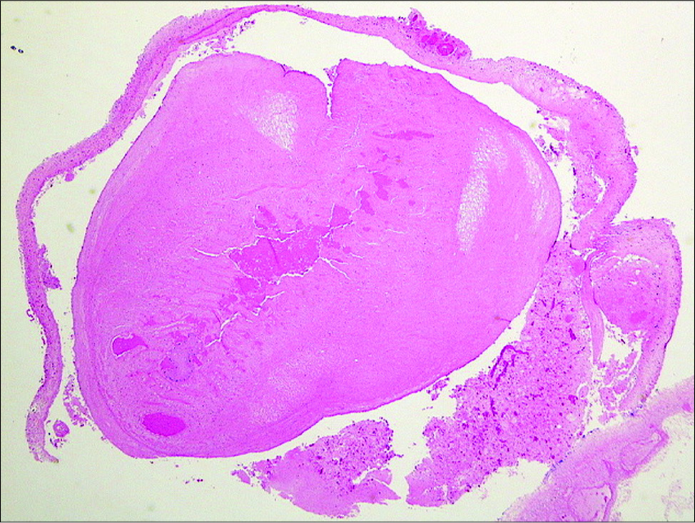 Hematoxylin and eosin stain showing degenerated cysticercus. The superior component in the early stage of degeneration, the scolex shows hyaline degeneration. The lower component is a more advanced stage, the wall is thickened and the scolex is transformed in coarse mineralized granules.