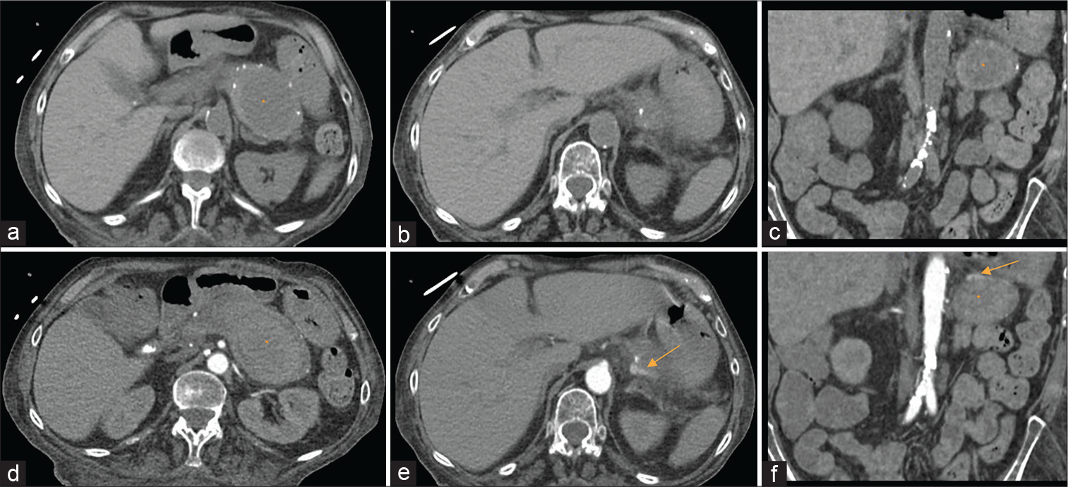 A 69-year-old female with splenic pseudoaneurysm secondary to a confirmed history of chronic pancreatitis, presenting with hematemesis, hemodynamic instability, and gastrointestinal bleed. Findings: Pre-contrast axial (a and b) and coronal (c) images of CT angiography of the abdomen and pelvis showed a collection (asterisk) inseparable from the pancreatic tail measuring 7.9 × 4.9 × 5.6 cm in three dimensions with peripancreatic inflammation. Small calcifications were detected surrounding the collection reflecting the pancreatic parenchyma consistent with the clinical history of chronic pancreatitis. Contrast-enhanced CT aortogram arterial phase axial (c and d) and coronal (f) images demonstrated shallow pooling of contrast along the superior aspect of the collection as evidenced by axial (e, arrow) and coronal (f, arrow) images, suggested of pseudoaneurysm of the splenic artery.