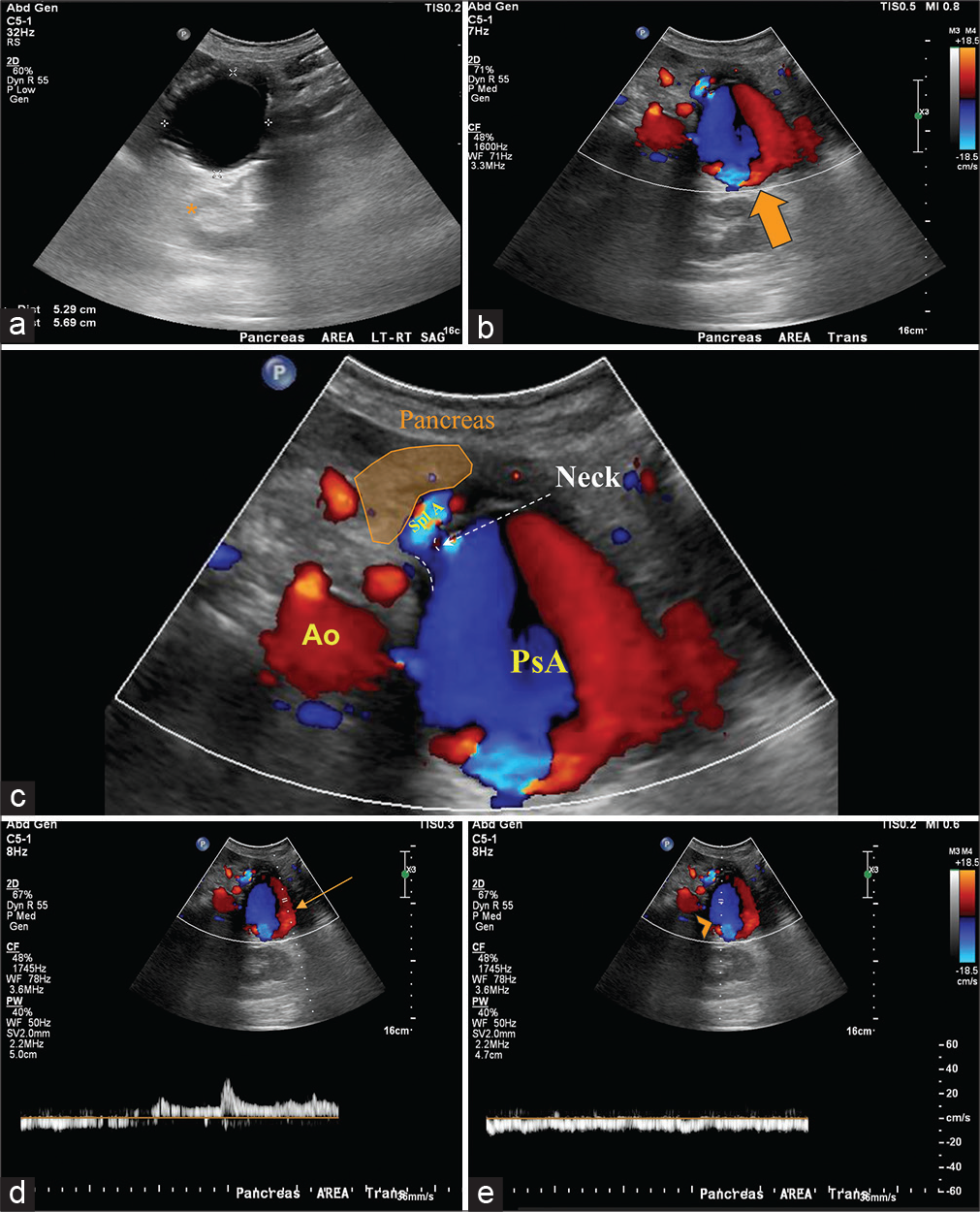 A 69-year-old female with splenic pseudoaneurysm secondary to a confirmed history of chronic pancreatitis, presenting with hematemesis, hemodynamic instability, and gastrointestinal bleed. Findings: Longitudinal gray scale transabdominal ultrasonography image (a) of the pancreatic region shows an anechoic lesion with posterior acoustic shadowing (asterisk) measuring 5.3 × 5.7 cm. Transverse color Doppler (b) sonogram demonstrated turbulent flow (red-blue) in the lesion. Thus, the structure should be vascular in its nature and is shown with the characteristic “yin-yang” sign (big arrow) compatible with pseudoaneurysm of the splenic artery as depicted by the magnified view (c). Note the pseudoaneurysm neck is illustrated (dashed lines). Color Doppler and spectral analysis (d and e) taken at the site of the pseudoaneurysm shows bidirectional blood flow of arterial (d, arrow) and venous flow (e, arrowhead) consistent with the to-andfro pattern. Ao: Aorta. Spl A: Splenic artery, PsA: Pseudoaneurysm.