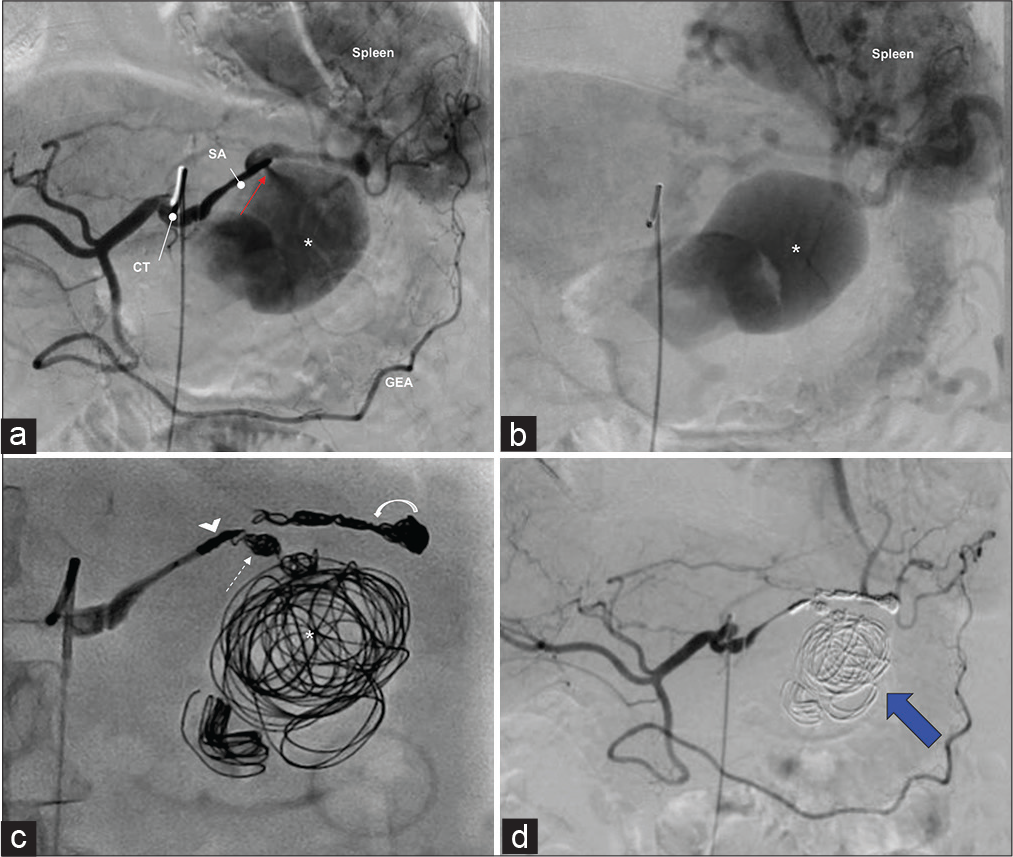 Selective digital subtraction angiograms showing pre- and post-embolization of a splenic artery pseudoaneurysm. Findings: A pre-intervention angiogram of the celiac trunk (a) shows a large pseudoaneurysm (asterisk) arising from the splenic artery (SA). There is a jet of contrast material from the splenic artery into the pseudoaneurysm that is compatible with extravasation (a, red arrow). Delayed angiogram (b) showing contrast blush suggestive of active bleeding from the pseudoaneurysm (asterisk). Note the spleen parenchyma blush is noted. (c) DSA shows the proximal inflow (arrowhead) and distal outflow (curved arrow) of the splenic artery along with the neck (dashed arrow) and pseudoaneurysm itself (asterisk) is packed with microcoils. (d) A post-intervention arteriogram demonstrates the successful exclusion of pseudoaneurysm by coil embolization (blue arrow). CT: Celiac trunk, GEA: Gastroepiploic artery, DSA: Digital subtraction angiogram.