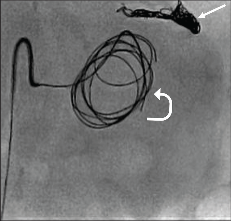 Findings: Digital subtraction angiogram shows that the neck of pseudoaneurysm is cannulated and detachable coils being deployed into the pseudoaneurysm (curved arrow). Note the distal splenic artery was embolized with coils (arrow) occluding the outflow tract since pseudoaneurysm is arising from splenic artery trunk, which has collateral supply.