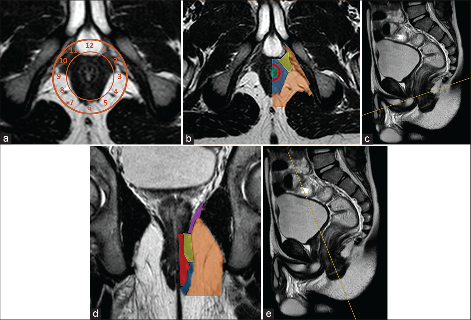 Half-Fourier acquisition single-shot turbo-spin-echo T2-weighted (haste T2-w) axial-oblique in a patient scanned in supine position (a) with clock benchmarks. The “anal clock” is a useful tool for reporting anorectal pathology. Anatomy of the anal region is showed on Haste T2-W axial-oblique scan (b), obtained perpendicularly to the anal canal long axis as showed on Haste T2-W sagittal reference scan (c), and coronal-oblique image (d), acquired in parallel with anal canal long axis as visible on sagittal Haste T2-W scan reference (e). Green area: Anal canal lumen; red line: Internal sphincter; blue area: External sphincter; yellow area: Puborectal muscle; purple line: Levator ani; orange area: Ischioanal fossa.