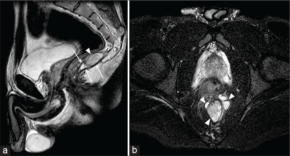 Resonance Imaging of the Anal Region Clinical Applications