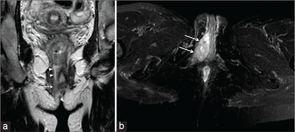 A 36-year-old female patient affected by ulcerative colitis (Mayo Stage II) complaining for vaginal pain and purulent drainage. Coronal-oblique half-Fourier acquisition single-shot turbo-spin-echo T2-weighted (HASTE T2-W) image (a) shows an intersphincteric fistula (arrowheads) within the right wall at the level of the third middle of the anal canal. The fistula extended anteroinferiorly to the right wall of the vagina, where an abscess (arrows) was detected on axial-oblique Haste T2- with fat saturation (b).