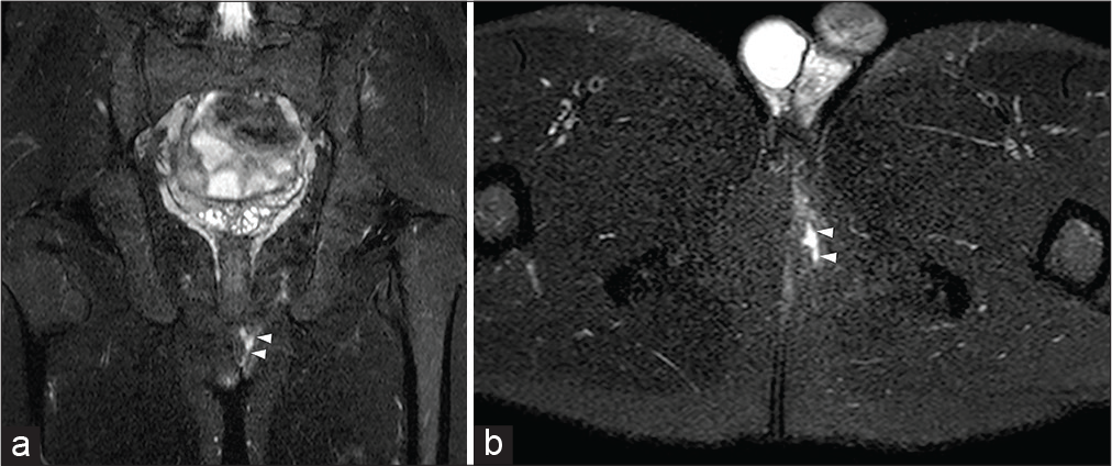 A 19-year-old male patient was suffering from Behcet disease and uveitis. The patient complained about anal pain and purulent drainage at the level of the left gluteus cutaneous surface. Coronal-oblique half-Fourier acquisition single-shot turbo-spin-echo T2-weighted (HASTE T2-W) (a) and axial-oblique HASTE T2-W (b) with fat saturation show a fistulous tract (arrowheads) arising from the lower third of the anal canal.