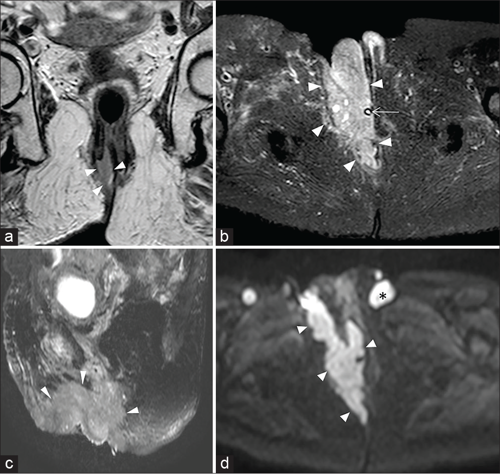 A 76-year-old female patient with large squamous cell carcinoma anal cancer. Coronal T2-weighted image (a) shows the origin of the mass from the middle-lower third of the anal canal (arrowheads). T2-W SPAIR sequences obtained on axial (b) and sagittal (c) planes and axial diffusion-weighted imaging at b value of 800 s/mm2 (d) demonstrates the anterior extension with involvement of the right vaginal wall and ipsilateral clitoral body and labium majus (arrowheads). Asterisk: Lymphadenopathy. Arrow: Urinary catheter.