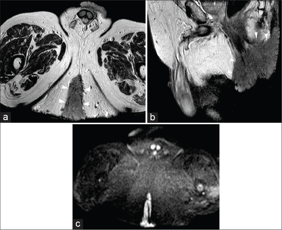 A 69-year-old male patient was affected by giant condyloma acuminatum, a rare verrucosus slow growth tumor often associated with human papillomavirus infection. Axial-oblique (a) and sagittal (b) half-Fourier acquisition single-shot turbo-spin-echo T2-weighted scans show a hypointense large mass (arrowheads) involving the anal canal as well as the cutaneous surface and the surrounding fatty gluteal tissues. On axial-oblique diffusion-weighted imaging image (c), the mass is characterized by significant hyperintensity.