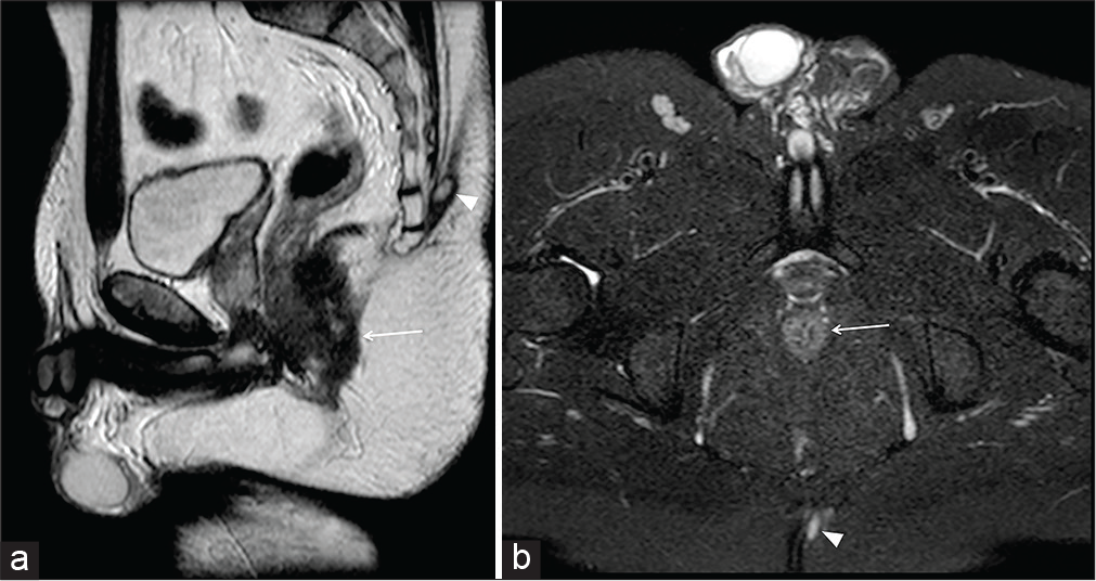 A 25-year-old male patient with swelling sensation at the higher level of the intergluteal cleft with occasional cutaneous fluid drainage. Sagittal half-Fourier acquisition single-shot turbo-spin-echo T2-weighted (HASTE T2-w) (a) and axial-oblique HASTE T2-W with fat saturation (b) show a small oval-shaped hyperintensity (arrowhead) within the left side of the intergluteal cleft, adjacent to the cutaneous surface. The absent communication with the anal canal (arrow) allowed the diagnosis of pilonidal sinus.