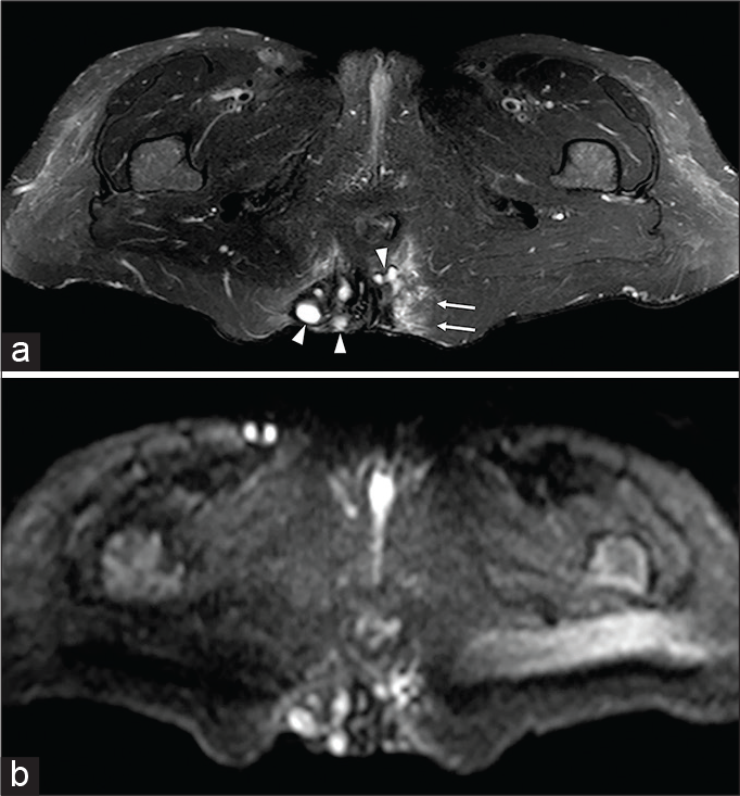 A 47-year-old female patient complaining of a diffuse painful swelling of the buttocks with associated cutaneous lumps. On axial half-Fourier acquisition single-shot turbo-spin-echo T2-weighted with fat-saturation (a) and axial diffusion-weighted imaging (b) several rounds and oval-shaped small hyperintense collections (arrowheads), due to fluid purulent content, are detectable together with edema of the surrounding gluteal fat tissue (arrows). The distance from the anal canal confirmed the clinical suspicion of hidradenitis.