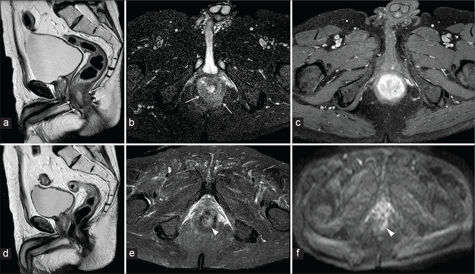 A 63-year-old male patient affected by moderately differentiated squamous cell carcinoma of the anus. Sagittal half-Fourier acquisition single-shot turbo-spin-echo T2-weighted (HASTE T2-W) (a) axial-oblique HASTE T2-W with fat saturation (b) demonstrates a concentric thickening of the anal walls (arrows), characterized by vivid enhancement on axial-oblique gradient echo T1-W with FS after gadolinium injection (c). The patient underwent chemotherapy and magnetic resonance imaging before the intervention. Sagittal HASTE T2-W (d) axial-oblique HASTE T2-W with FS (e) showed a significant reduction of the malignancy with residual thickening of the left posterior wall (arrowheads) confirmed by oblique-axial diffusion-weighted imaging (f).