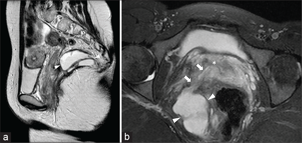 A 24-year-old female patient suffering from abundant pus drainage through the vagina occurred after a pelvic intervention for deep endometriosis. Sagittal half-Fourier acquisition single-shot turbo-spin-echo T2-weighted (HASTE T2-W) image (a) shows a sizeable multiloculated abscess (arrowheads) located within the right levator ani (thin arrows). Axial-oblique HASTE T2-W with fat-saturation zoomed reconstruction (b) shows the fistulous communication (thick arrows) between the abscess and the vaginal lumen (asterisk).