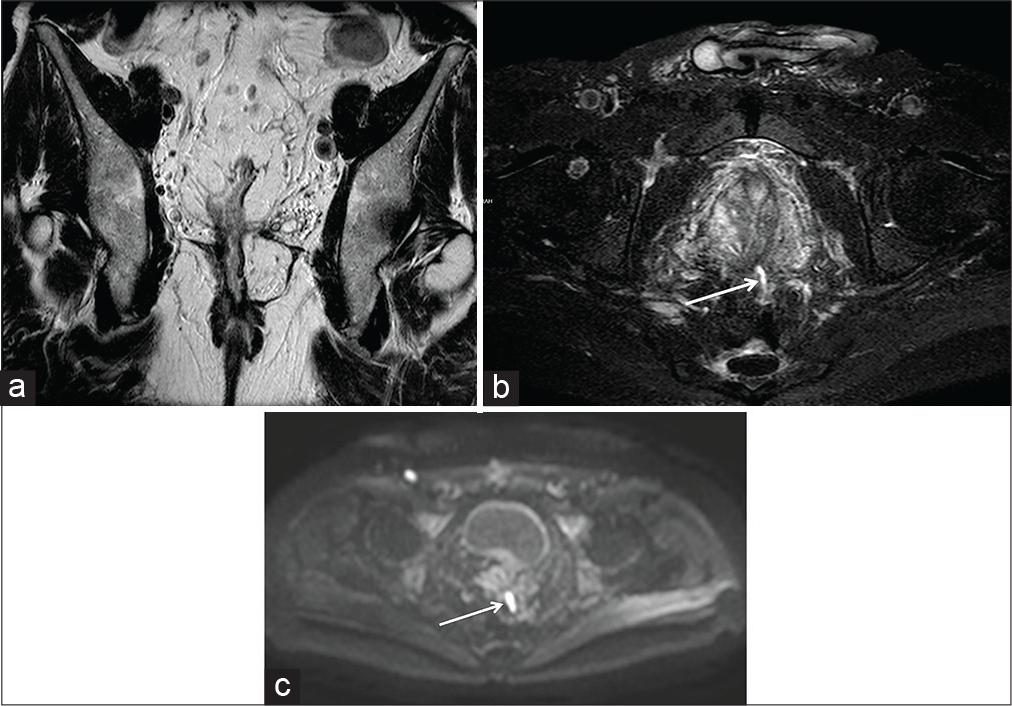 A 55-year-old male ulcerative colitis patient who underwent radical colectomy with ileal pouch-anal anastomosis surgery, appreciable on coronal-oblique half-Fourier acquisition single-shot turbo-spin-echo T2-weighted (HASTE T2-W) scan (a). At the time of magnetic resonance imaging, 16 years after the intervention, a small sinus tract (arrow) of the anterior wall of the pouch was detectable on axial-oblique HASTE T2-W with fat saturation (b) and axial diffusion-weighted imaging (c) scans.