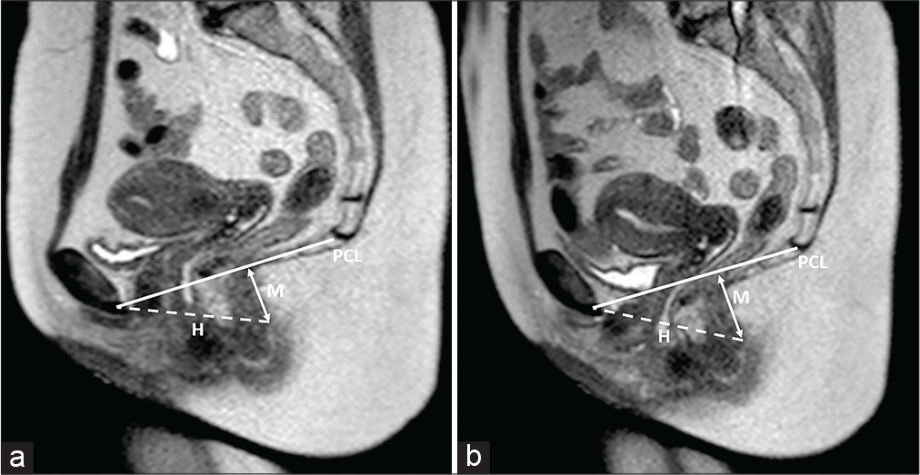 A 41-year-old female patient was suffering from chronic constipation, hemorrhoids, and internal prolapse of rectal mucosa. Sagittal T2-weighted half-Fourier acquisition single-shot turbo-spin-echo sequences obtained at rest (a) and during the Valsalva maneuver (b). Visceral prolapse and pelvic floor relaxation degree can be assessed through the assessment of three lines: the pubococcygeal (PCL; continuous line), drawn from the last coccygeal joint to the inferior border of the pubic symphysis; the “H-line” or “levator hiatus width” (dash line), drawn from the pubis to the posterior wall of the anorectal junction; and the “M-line” or “muscular pelvic floor relaxation line” (arrowed line), which is perpendicular to the pubococcygeal and reaches the posterior wall of the anorectal junction. Typically, the H and M lines should not exceed 5 cm and 2 cm in length. In the case presented, while the “H-line” did not modify between the two sequences, the “M-line” was measured 2.6 cm at rest and 3.8 cm during Valsalva maneuver performance.