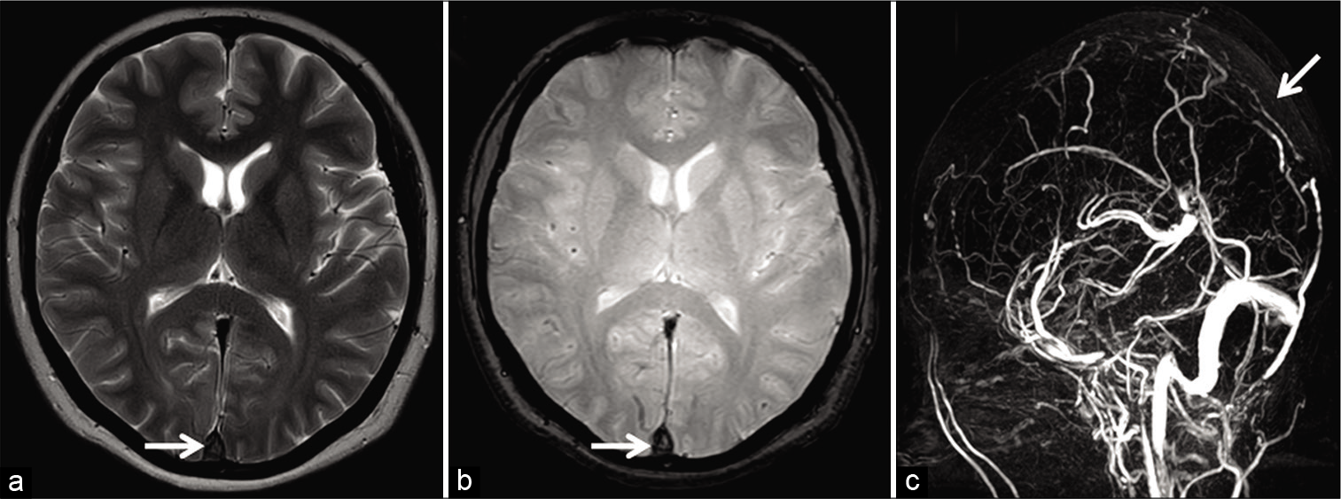 Appearance of acute dural sinus thrombosis in a 37-year-old patient presenting with acute headache. Axial T2W image (a) reveals a hypointense signal within the superior sagittal sinus (SSS) mimicking a flow void (arrow). Axial gradient recalled echo image (b) demonstrates “blooming” within the sinus suggesting a thrombus (arrow). Sagittal maximum intensity projection of the phase-contrast magnetic resonance venography (c) confirms an occlusion of the SSS (arrow).