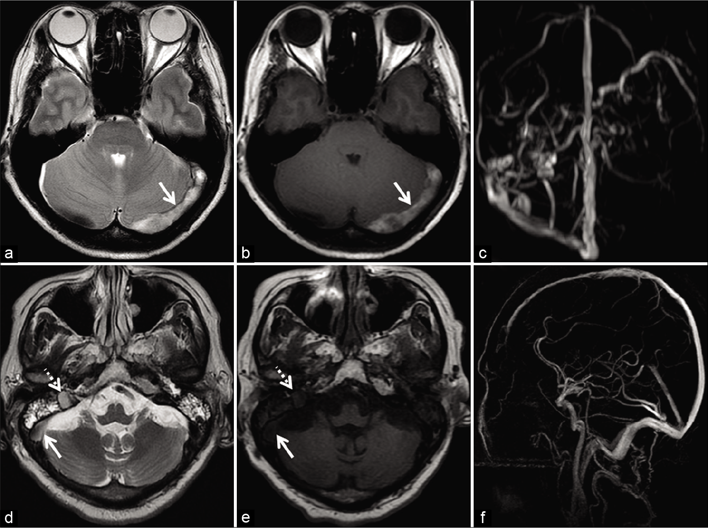 Deducing the etiology of loss of flow voids in two different patients. Patient 1 (a-c) was investigated for headache localized to the occipital region. Axial T2W image (a) and axial T1W image (b) show loss of flow void within the left transverse sinus (arrow). Maximum intensity projection (MIP) of the phase-contrast magnetic resonance venography (PC-MRV) (c) confirms the occlusion. Patient 2 (d-f) was imaged for headache associated with blurring of vision. Axial T2W image (d) shows loss of flow void within the right transverse sinus (solid arrow) and sigmoid sinus (dotted arrow). Corresponding axial T1W image (e) shows isointense signal intensity within the sinuses. Sagittal MIP of the PC-MRV (f) confirms patency of the sinuses. The signal alteration is therefore attributed to slow flow.