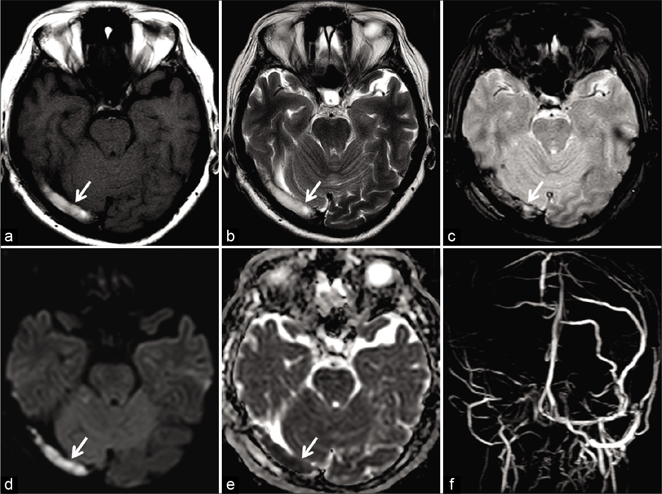 Magnetic resonance (MR) appearance of subacute dural sinus thrombosis in a 50-year-old patient. Unenhanced axial T1W image (a) and axial T2W image (b) show hyperintense signal within the right transverse sinus (arrow). Axial gradient recalled echo image (c) shows “blooming” artifact in the right transverse sinus (arrow). Restricted diffusion is also noted on the diffusion-weighted imaging image (d) andapparent diffusion coefficient image (e). Occlusion was confirmed on the phase-contrast MR venography (f).