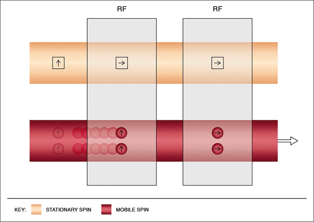 Physics of entry slice phenomenon. This results in a bright artifactual signal of mobile spins in the initial images, with gradual fading on the subsequent slices. It occurs due to unsaturated spins flowing into the imaging plane, previously saturated by the short interval radiofrequency pulses. The mobile spins get progressively saturated with resultant hypointense signals as they flow into the imaging volume and experience the repeated pulses.