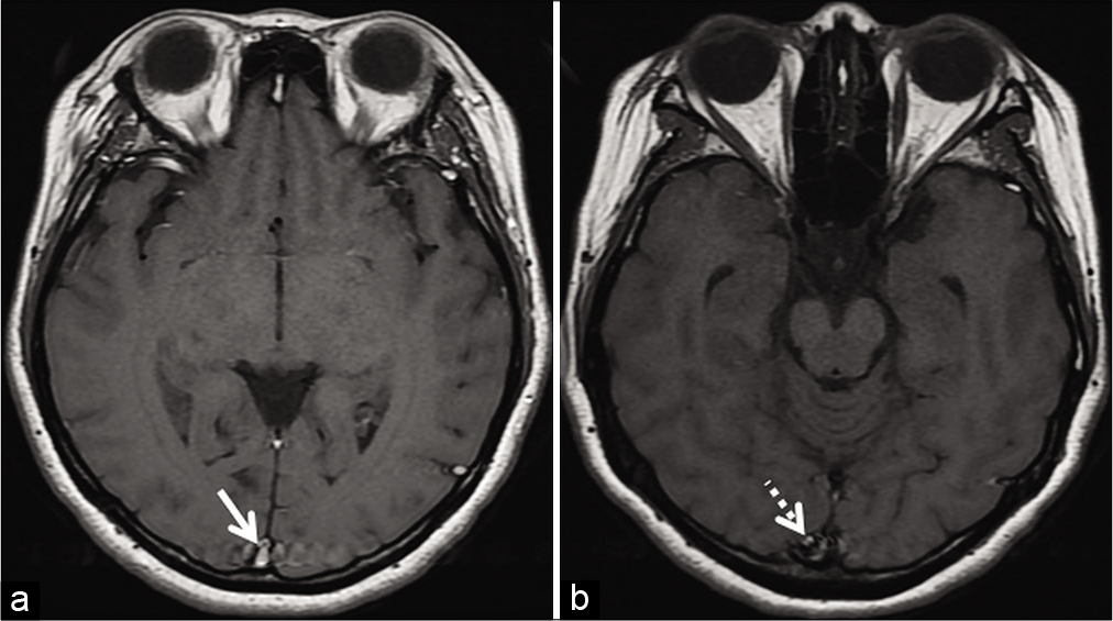 Example of entry slice phenomenon. Axial T1W image (a) of an internal acoustic meatus protocol study shows a brightsignal in the superior sagittal sinus (arrow) only on the initial sliceof the study. The contiguous caudal slice (b) shows fading off, ofthe signal intensity (dotted arrow).