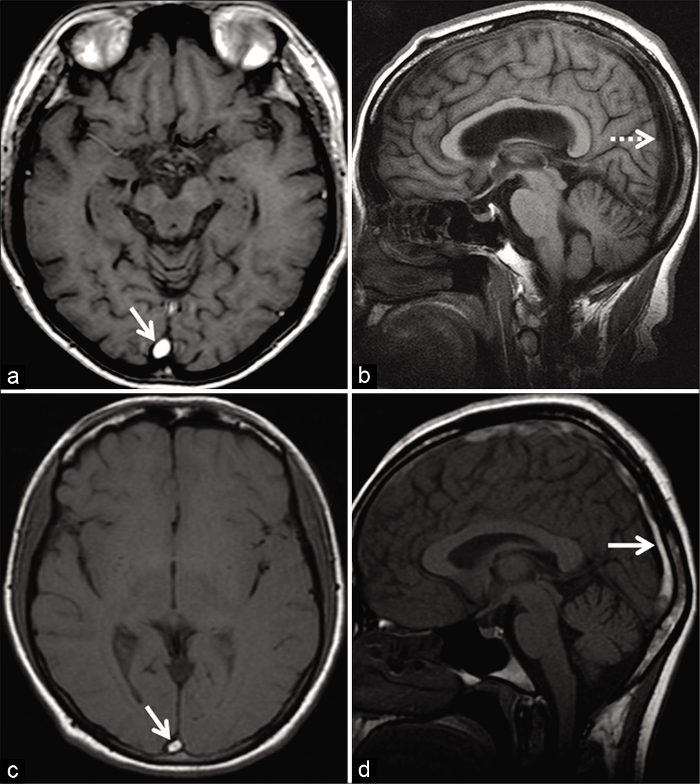 Method to differentiate entry slice phenomenon from thrombosis in two different patients. Patient 1 (a and b) was imaged for the investigation of left facial weakness using the internal acoustic meatus protocol. Axial T1W image (a) shows a hyperintense signal in the superior sagittal sinus (SSS) (arrow) only on the initial slice of the imaging volume. Sagittal T1W image (b) of the same patient, obtained during the same examination, demonstrates normal signal void within the SSS. The loss of bright luminal signal on changing orientation of acquisition indicates entry slice phenomenon. Patient 2 (c and d), a 45-year-old patient, was on follow-up for dural sinus thrombosis involving the SSS. Axial T1W image (c) shows a hyperintense signal in the SSS (arrow). The signal intensity persists even after obtaining an orthogonal sagittal T1W image (d). This suggests that the T1 hyperintense signal abnormality (c and d) is a true subacute thrombus rather than an artifact.