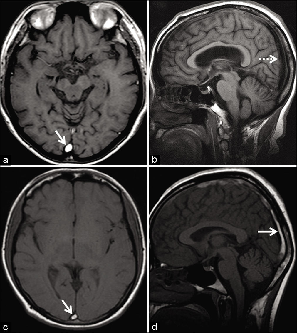 Transverse Sinus Mri