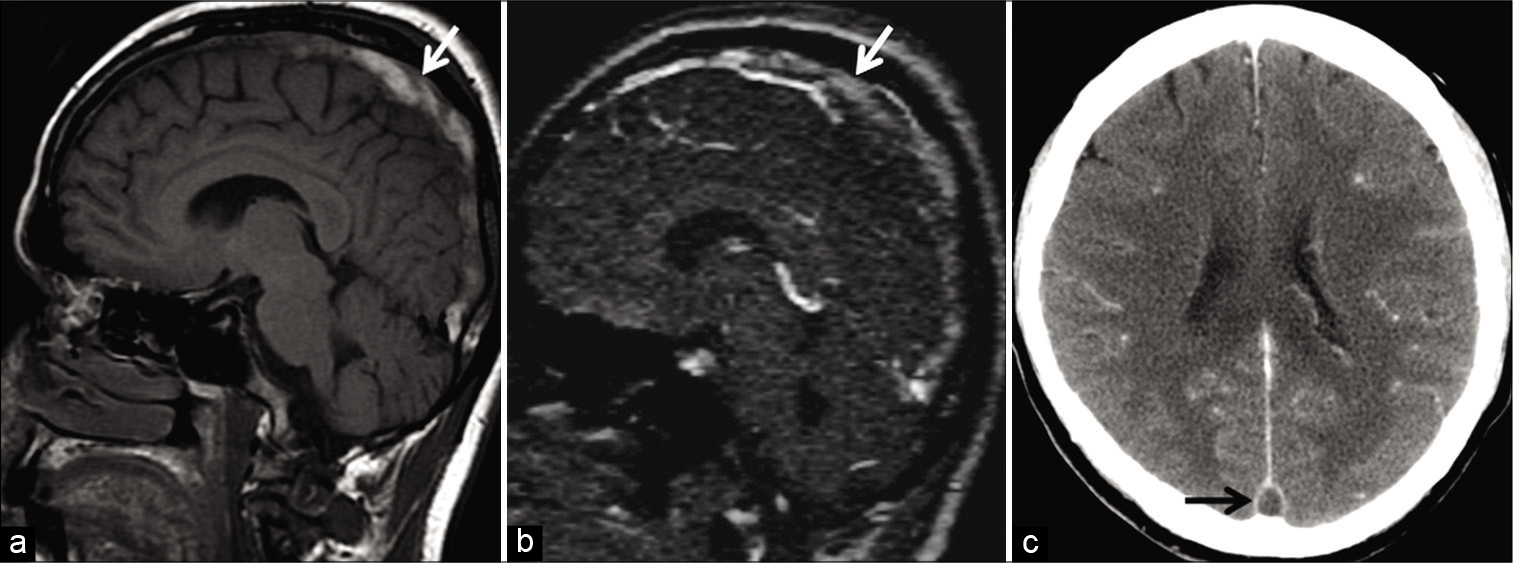 Example of “thrombus shine through” in a 58-year-old patient presenting with headache. Unenhanced sagittal T1W image (a) shows a hyperintense subacute thrombus in the superior sagittal sinus (SSS) (arrow). This appears as a faint “shine through” (arrow) on sagittal reconstructions of the time-of-flight MR venography (b) due to the short TR interval used in this imaging technique. Note the filling defect seen in the SSS (arrow) on the follow-up contrast-enhanced CT image (c) confirming sinus occlusion.