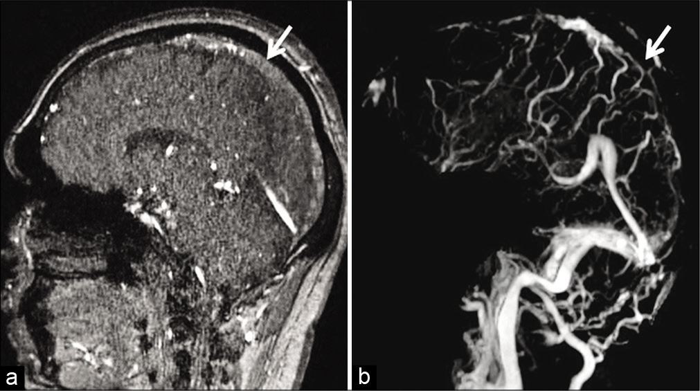 Example of “thrombus shine through” due to subacute dural sinus thrombosis (DST) in a 41-year-old patient. Sagittal source time-of-flight magnetic resonance (MR) venography image (a) shows a mild hyperintense signal in the superior sagittal sinus (SSS) (arrow) due to subacute DST. Occlusion of the SSS (arrow) is confirmed on the post-subtraction contrast-enhanced MR venography image (b).