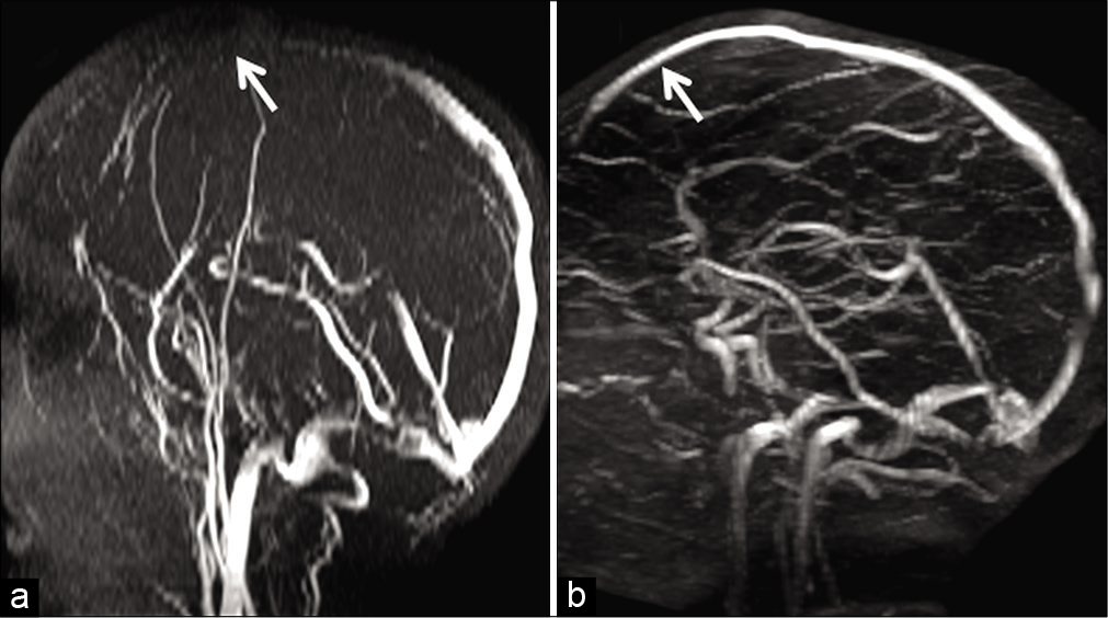 Example of in-plane saturation and its correction in a 6-year-old child presenting with febrile convulsions. Maximum intensity projection image of a time-of-flight MR venography (a) acquired in the axial plane demonstrates loss of flow signal in the anterior portion of the superior sagittal sinus (SSS) (arrow). Orthogonal switching to a coronal plane of acquisition (b) helps to confirm patency of the anterior SSS (arrow). The initial signal loss in (a) is hence confirmed to be artifactual due to in-plane saturation.