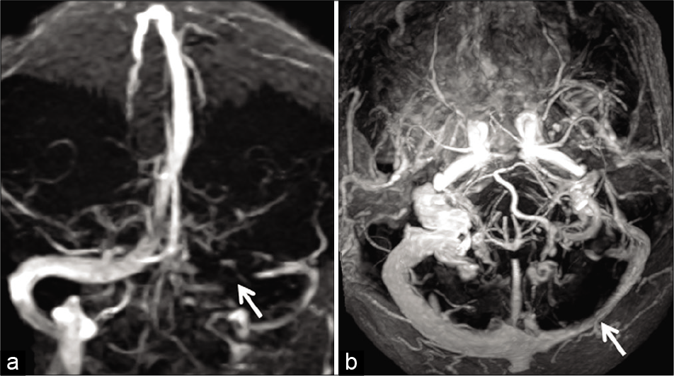 Example of “flow gap” in a 70-year-old patient imaged before resection a right frontal meningioma. Time-of-flight magnetic resonance venography (TOF-MRV) image (a) (coronal acquisition) shows signal loss within the proximal left transverse sinus (arrow). Flow signal distally is preserved. Axial maximum intensity projection image of the contrast-enhanced magnetization prepared rapid gradient echo (MPRAGE) (b) confirms hypoplasia of the transverse sinus with adequate luminal enhancement throughout the sinus (arrow). The loss of signal on the TOF-MRV is, therefore, confirmed to be a “flow gap.”