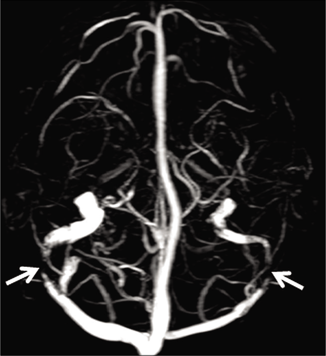 Phase-contrast magnetic resonance venography (PCMRV) (using a velocity encoding gradient [VENC] 15 cm/s) in a 45-year-old female patient with idiopathic intracranial hypertension. Maximum intensity projection of the PC-MRV (VENC 15 cm/s) demonstrates focal symmetric signal losses in lateral portions of both the transverse sinuses due to underlying stenosis (arrows).