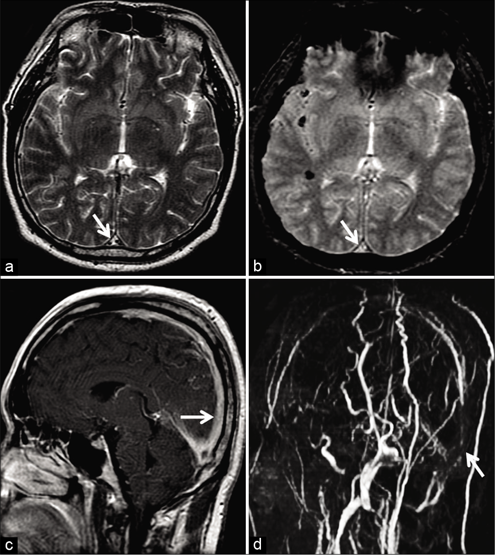 Example of chronic thrombosis in a 68-year-old patient on 6 monthly follow-ups after medical management of dural sinus thrombosis involving the superior sagittal sinus (SSS). Axial T2W image (a) shows a hyperintense intraluminal signal within the SSS (arrow) with no blooming on the axial gradient recalled echo image (b). Sagittal post-contrast T1W image (c) shows avid enhancement within the sinus (arrow). Overall, these findings are easy to be misinterpreted as patency. Maximum intensity projection of the phase-contrast MR venography (d) reveals absent flow signals within the SSS (arrow), confirming the diagnosis of a chronic occlusion.