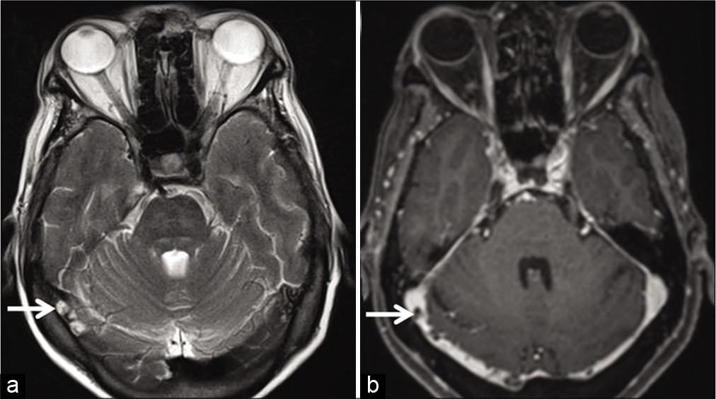 Transverse Sinus Mri