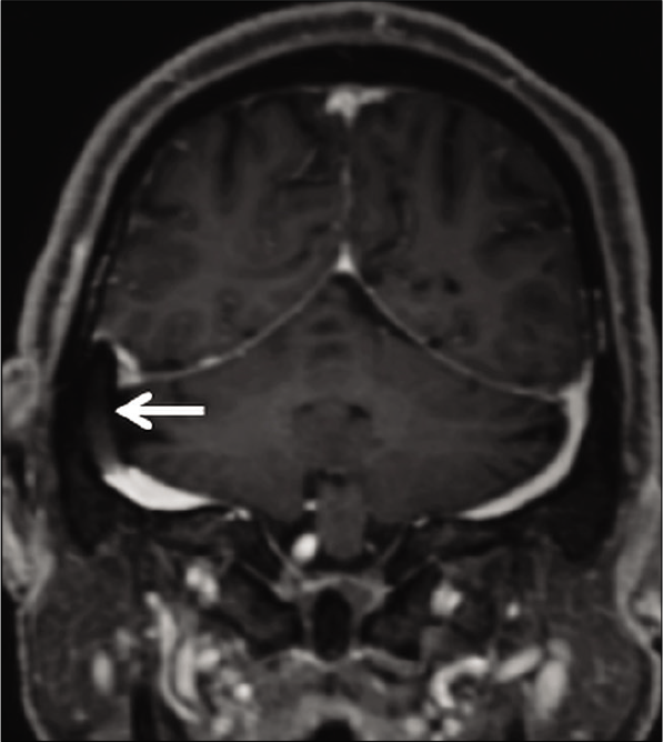 Appearance of endovascular stenting of the right transverse sinus, as a part of the management of idiopathic intracranial hypertension. Contrast-enhanced magnetization prepared rapid gradient echo shows a filling defect within the right transverse sinus (arrow) which represents the stent.