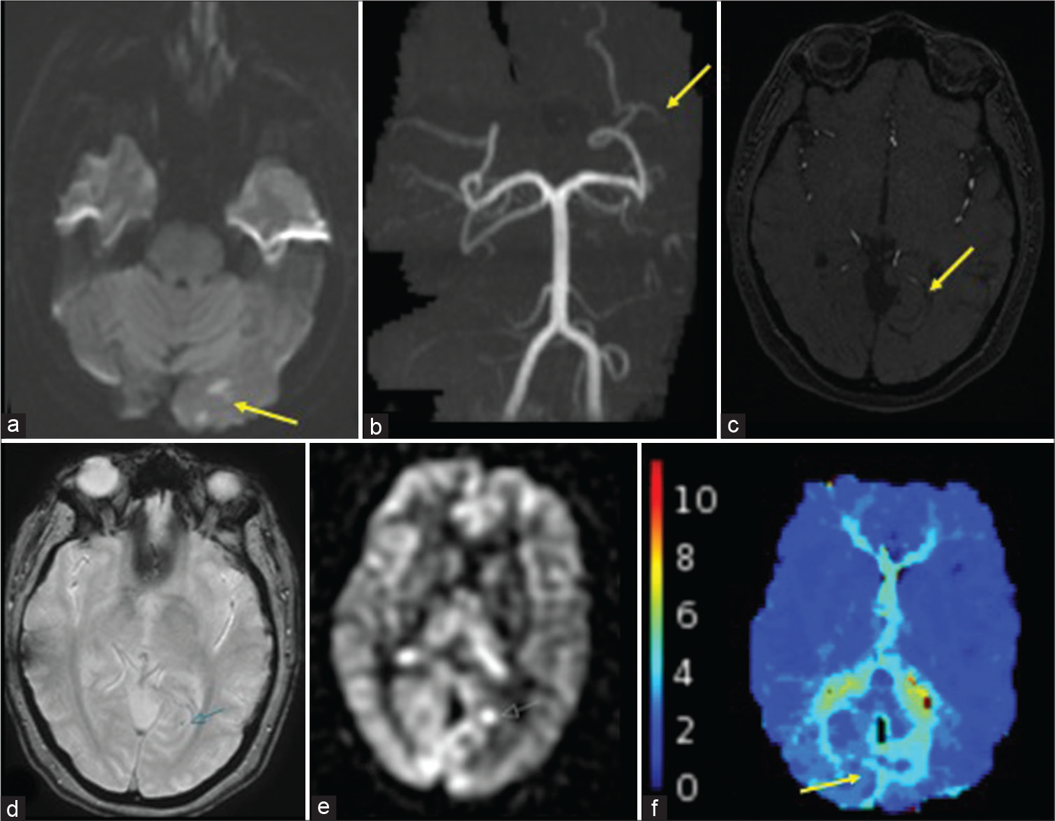 A 48-year-old female with the left occipital infarcts. (a) DWI shows multiple infarcts within the left occipital lobe (yellow arrow). (b and c) TOF MRA shows the occlusion of a distal left P3 branch (yellow arrows). (d) GRE shows a punctate focus thought to represent intravascular clot (blue arrow). (e) ASL shows a focus of increased signal at the occlusion site (white arrow). (f) Tmax delay is noted in the medial left occipital lobe (yellow arrow).