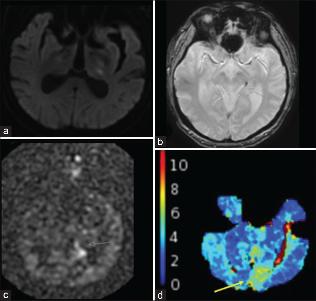 A 79-year-old male with the left thalamic infarcts. (a) DWI shows the punctate infarcts within the left dorsolateral thalamus. (b) GRE shows intravascular clot within the left P2 segment (white arrow). (c) ASL shows increased intravascular signal distal to the left P2 occlusion (white arrow). (d) Tmax delay is demonstrated within the left medial occipital lobe in the left PCA territory (yellow arrow).