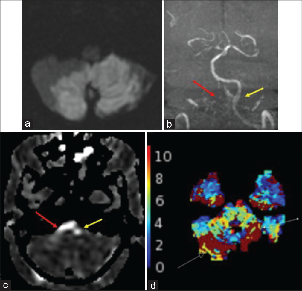 A 59-year-old male with infratentorial infarcts. (a) DWI shows infarcts involving the cerebellar hemispheres bilaterally and vermis. (b) TOF MRA shows compete and partial occlusions (red arrow) of the right and left (yellow arrow) V4 segments, respectively. (c)ASL shows increased intravascular signal within the bilateral V4 segments (right V4, red arrow; left V4, yellow arrow). (d) Tmax was motion degraded and partially evaluated the infratentorial brain, limiting diagnostic evaluation, but showed questionable abnormality in the infarcted regions (white arrows).