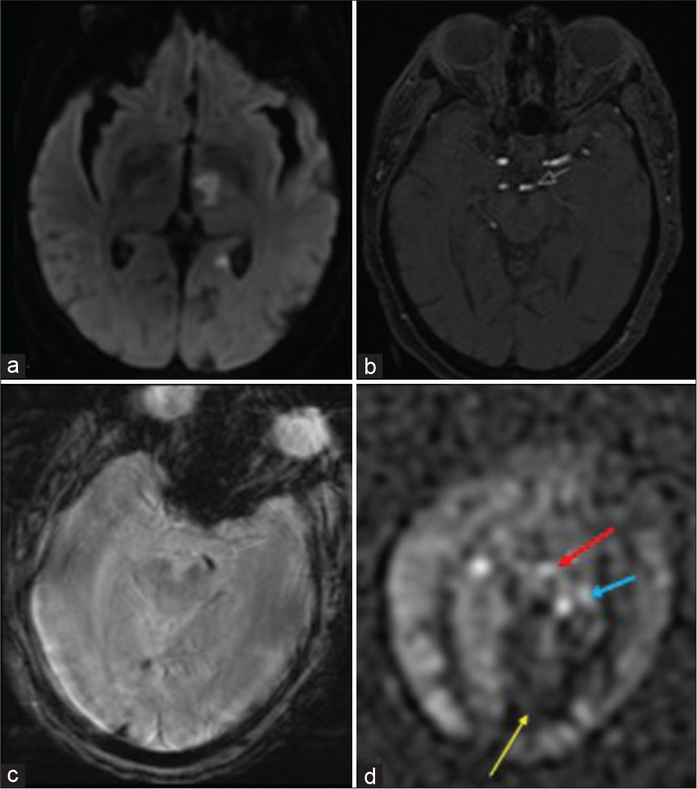 A 60-year-old female with acute kidney injury who was found to have a left PCA infarct. (a) DWI shows acute infarcts in the left anterior thalamus with involvement of the posterior limb of the internal capsule as well as the left hippocampal tail. (b) TOF MRA shows an abrupt cutoff representing the occlusion. (c) GRE shows corresponding intravascular clot. (d) ASL shows increased intravascular signal both proximal and distal to the left P1 occlusion (red/white and blue arrows respectively) in addition to decreased signal in the left medial occipital lobe (yellow arrow).