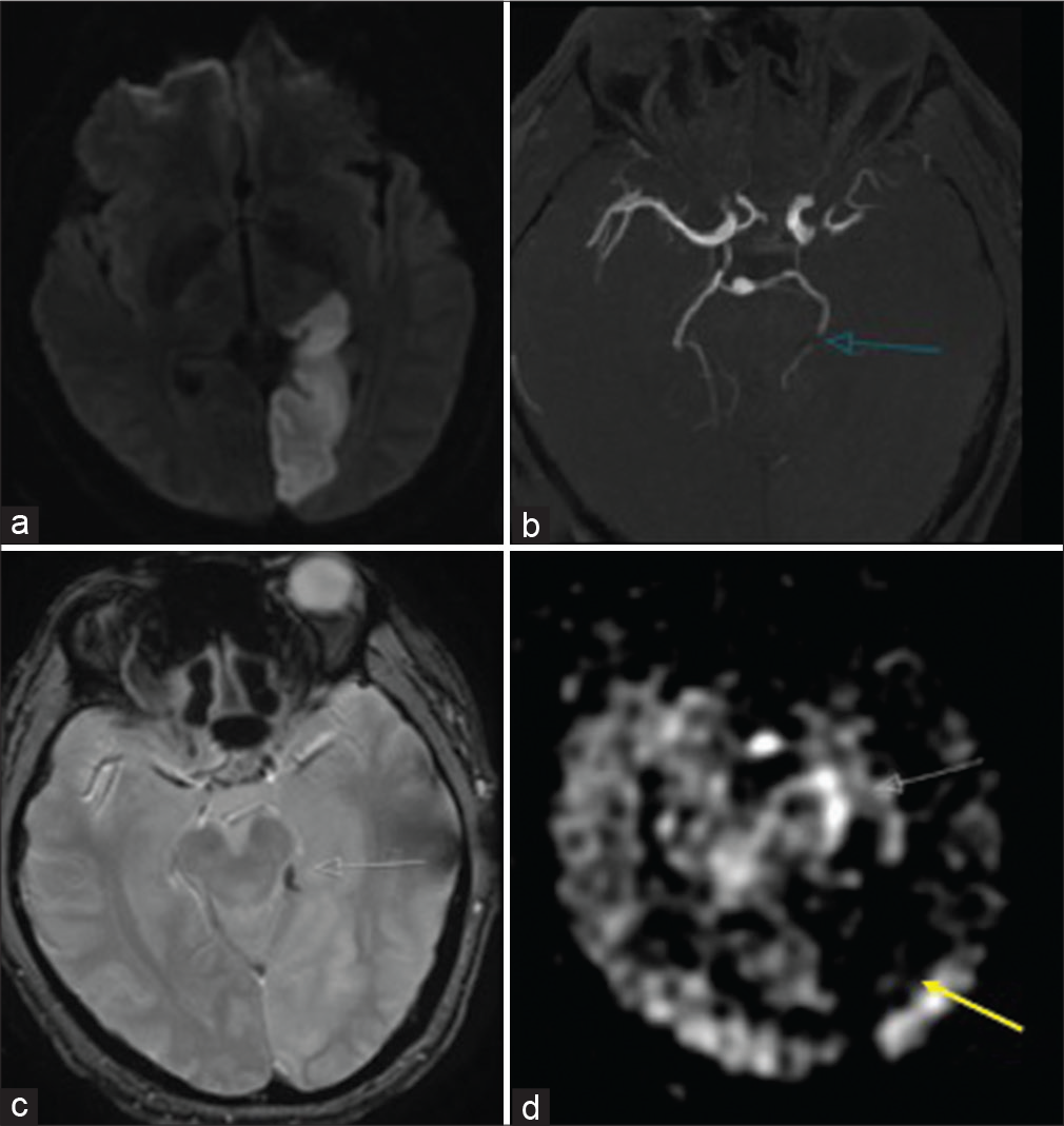 A 54-year-old male with acute kidney injury found to have a left PCA infarct. (a) DWI shows the extent of the left PCA infarct. (b) TOF MRA shows the abrupt cutoff of the left P2 segment compatible with occlusion (blue arrow). (c) GRE shows corresponding intravascular clot (white arrow). (d) ASL shows increased intravascular signal proximal to the left P2 occlusion (white arrow) with decreased signal in the left medial occipital lobe (yellow arrow).