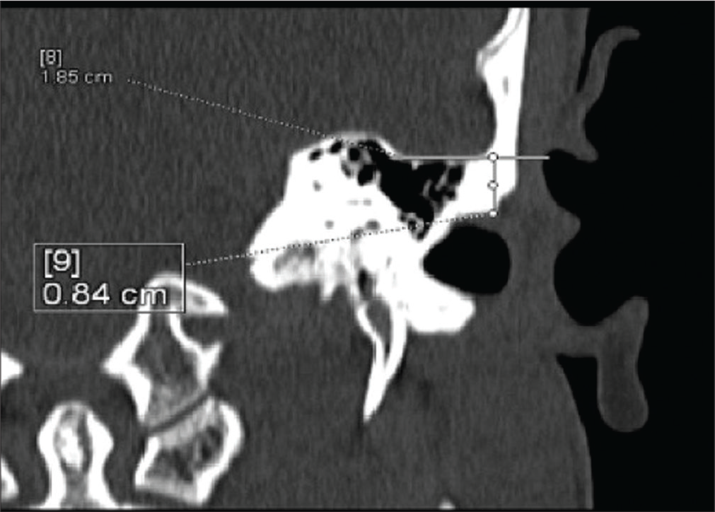 A 40-year-old man who presented with fever and ear pain with diagnosis of chronic otitis media. CT scan coronal image showing left sided tegmen height measuring ~ (8.4) mm.