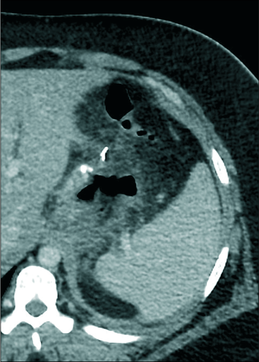 A 34-year-old female patient presented with the left shoulder and chest pain, enhanced computed tomography scan image showing a gas leak only adjacent to the proximal gastric ruminant pouch.